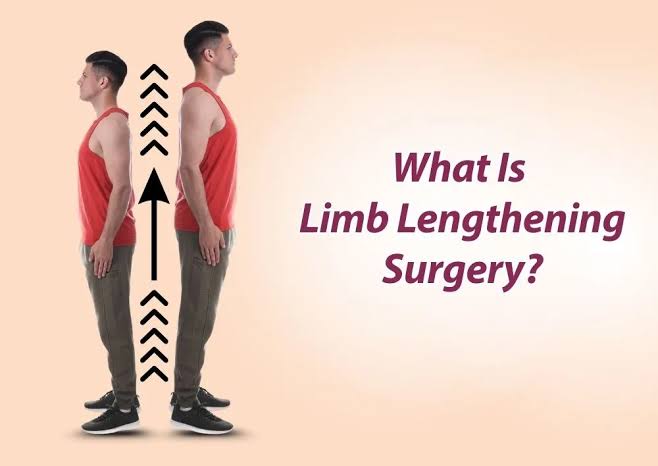 Limb Lengthening Surgery