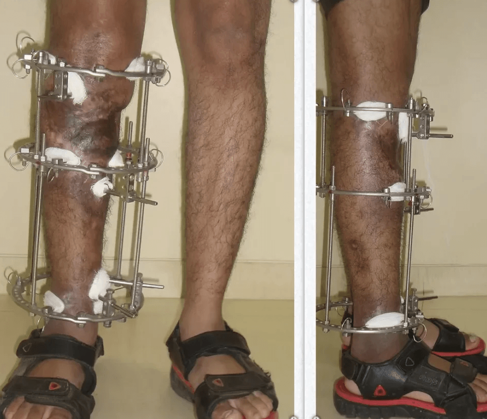 Limb Reconstruction